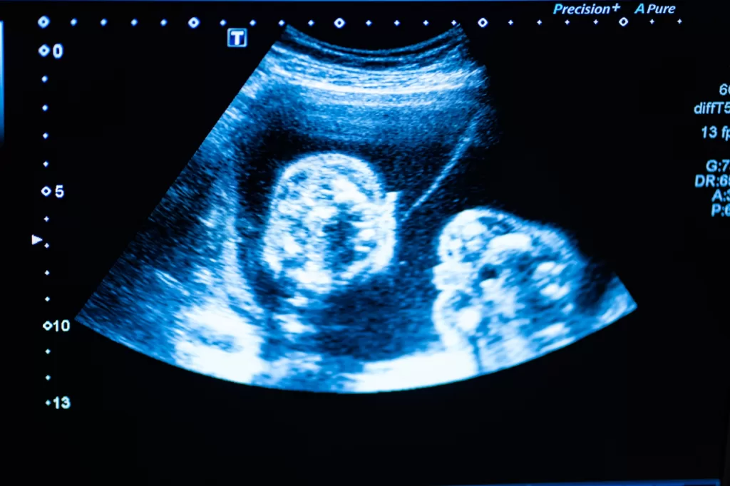Monitor during ultrasound examination. Pregnancy.
