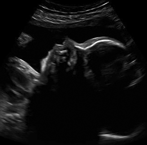 2D Ultrasound in castleton